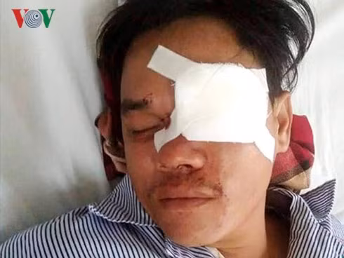Anh Lê Tấn Sinh bị đâm hỏng hỏng mắt trái. Ảnh: C.A