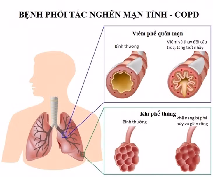 Bệnh phổi tắc nghẽn mãn tính. Ảnh: Internet