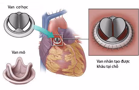 Thay van tim được thực hiện dựa theo mức độ tổn thương van.