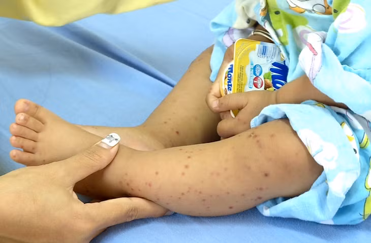 Các nốt phỏng nước là một trong những biểu hiện rõ nét của bệnh Tay chân miệng