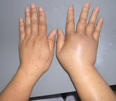 Ăn quá ít muối khiến lượng natri máu giảm gây hiện tượng phù tay, chân do nước tự do thoát ra ngoài khoảng kẽ.