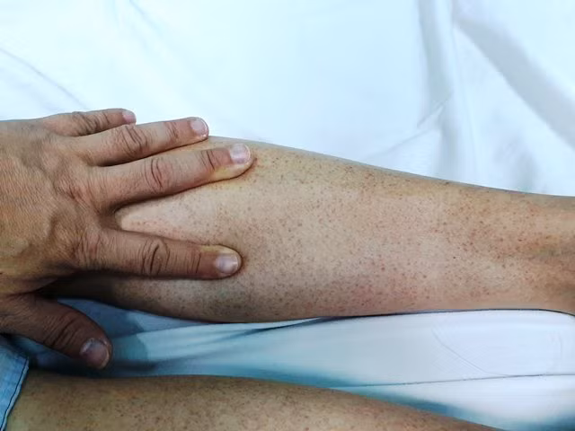 Một trường hợp điển hình của bệnh SXH với dấu hiệu xuất huyết dưới da ở cẳng chân.