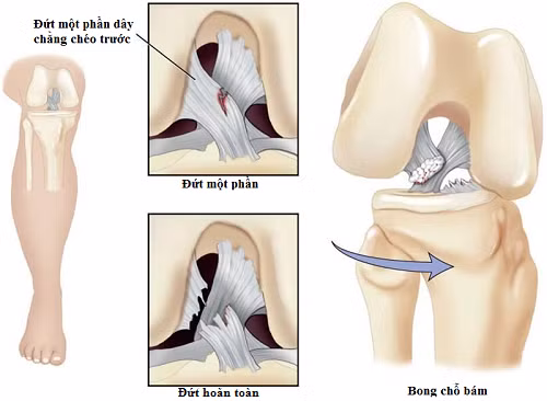 Các hình thái tổn thương của đứt dây chằng chéo trước.