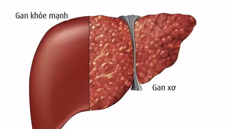 Gan dễ bị tổn thương nếu dùng quá liều paracetamol.