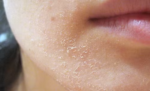 Da khô gây nhiều bệnh về da.