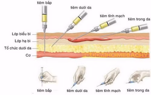 Các đường tiêm thường được áp dụng cho người bệnh.