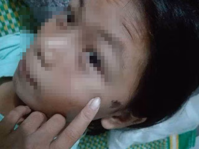  Bé gái 12 tuổi bị công an viên đánh phải đi bệnh viện
