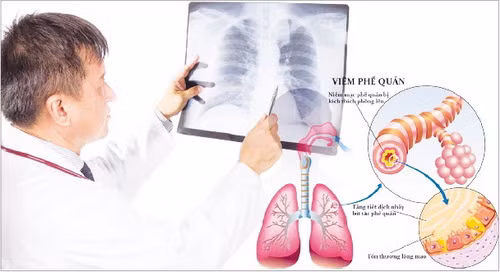 Ðông y gọi viêm phế quản là khái thấu, đàm ẩm. Nguyên nhân do ngoại cảm phong hàn, phong nhiệt, khi táo hoặc do công năng của 3 tạng phế, tỳ, thận giảm sút.