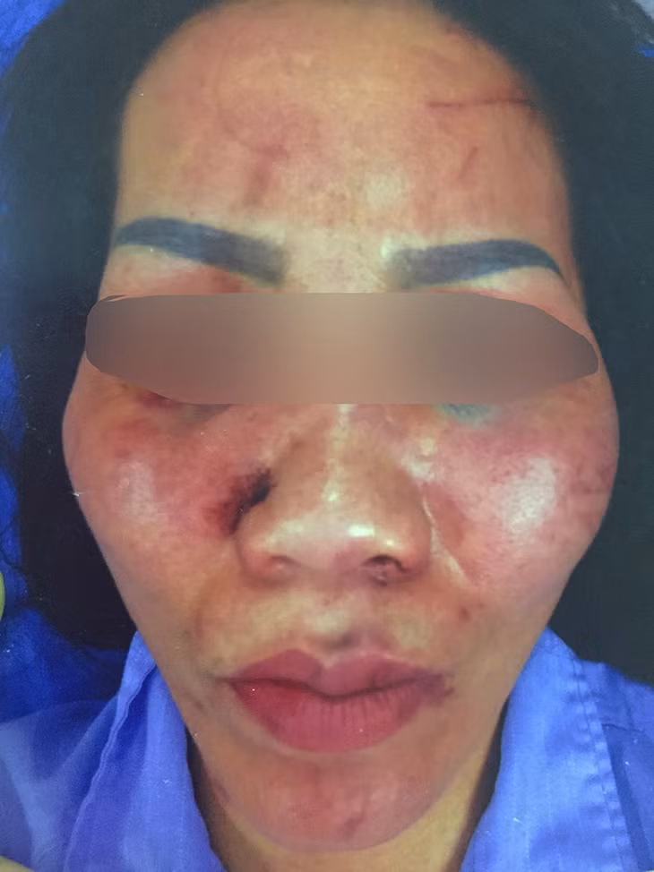 Chị H bị đánh nhóm người đánh phải nhập viện điều trị.