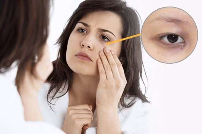 Bạn không nên chủ quan khi xuất hiện quầng thâm ở mắt kéo dài.