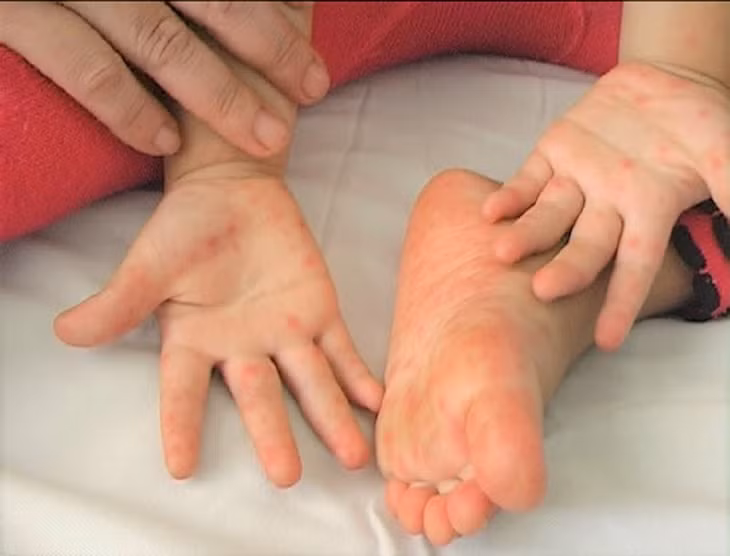 Biểu hiện của bệnh tay chân miệng. (Ảnh minh hoạ)