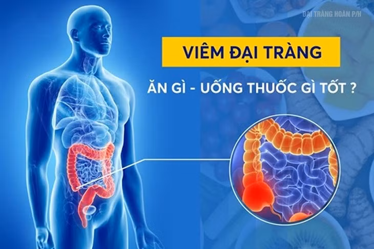 Viêm đại tràng diễn tiến âm thầm vì ban đầu, các triệu chứng có thể chỉ là cảm giác đầy bụng, khó tiêu, đau bụng, tiêu chảy…khiến người bệnh dễ dàng bỏ qua (ảnh minh hoạ)