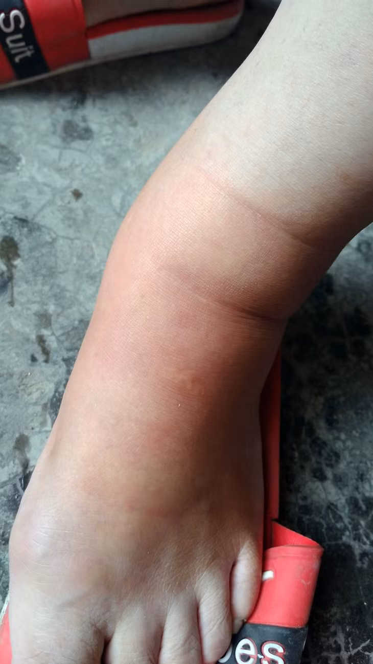 Những vết kiến đốt gây sưng tấy. Nhiều trường hợp đã phải đi cấp cứu tại bệnh viện.