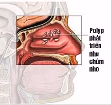 Polyp phát triển như chùm nho cản trở không khí đi qua mũi gây nghẹt mũi.