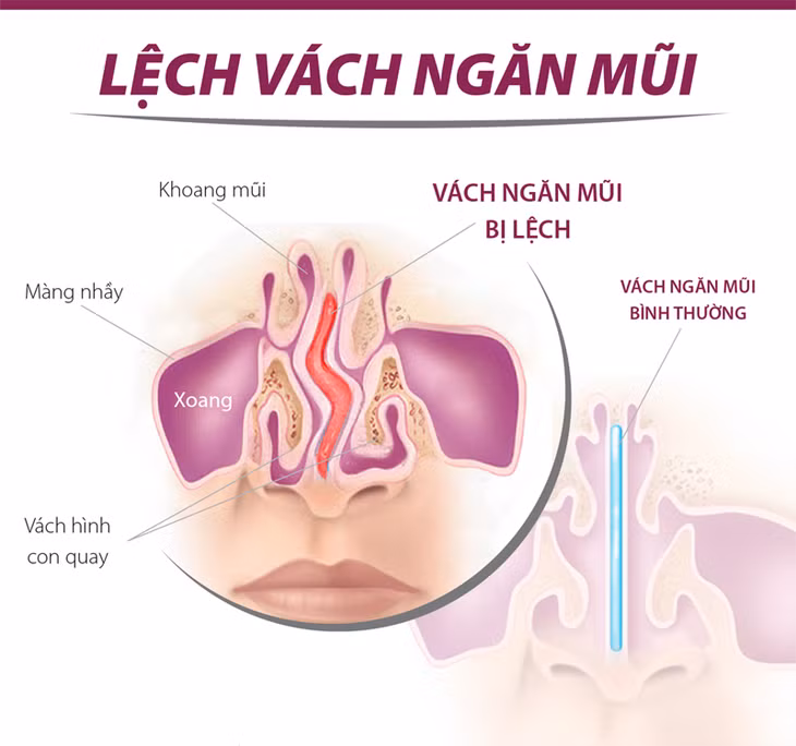 Lệch vách ngăn mũi cũng là nguyên nhân gây nghẹt mũi.