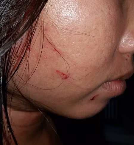 Vết thương trên người chị Nguyễn Thị Mỹ Hòa (ảnh do gia đình chị Hòa cung cấp)