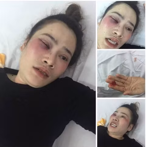 Chị Như bị đa chấn thương vùng mặt, công an xác định tỉ lệ thương tích là 4%