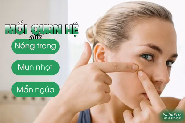 Tình trạng nổi mụn nhọt, mẩn ngứa kéo dài kèm theo các biểu hiện như vàng da, táo bón thì khả năng cao bạn đã bị nóng trong người (ảnh minh hoạ)