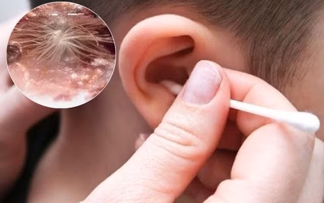 Ngứa tai là một trong những biểu hiện của bệnh viêm ống tai ngoài.