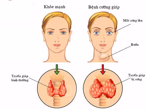 Một số dấu hiệu cơ bản của bệnh cường giáp