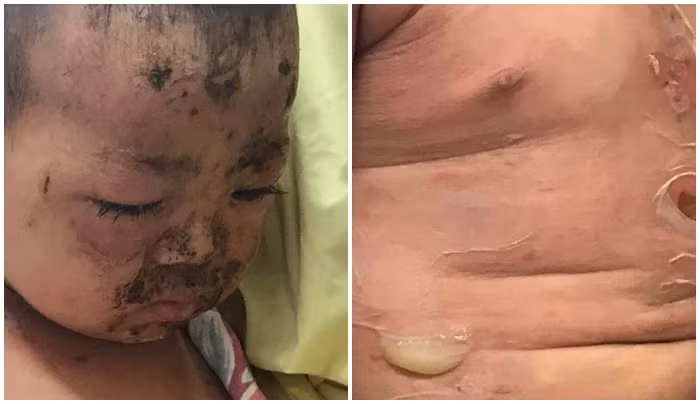 Trẻ trong tình trạng trợt da, viêm loét toàn thân