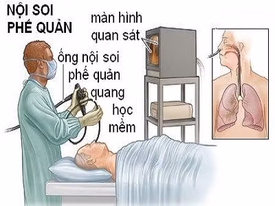 Hình ảnh minh họa Nội soi phế quản