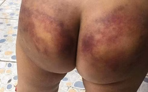 Mông bé trai với những vết bầm tím còn mới