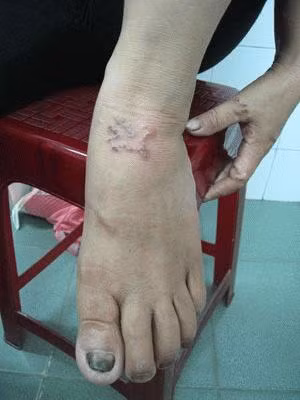 Bệnh hiếm ở Hải Phòng: 'giun bò dưới da' ảnh 1