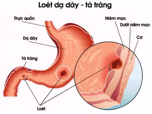 Hình ảnh loét dạ dày - tá tràng.