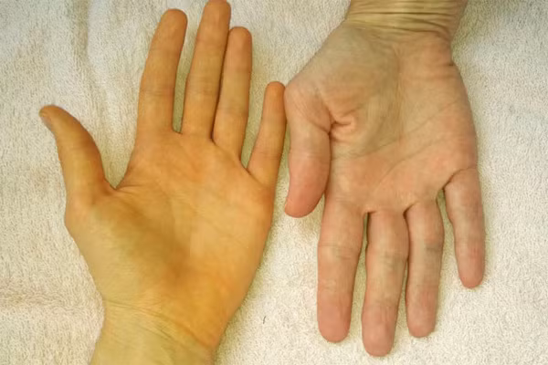Nước da chuyển màu vàng là một triệu chứng của bệnh liên quan tới gan. Ảnh: PCA
