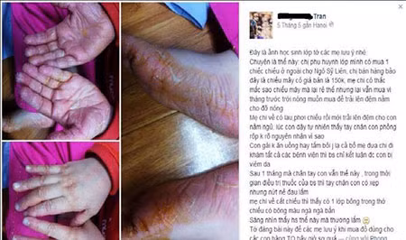 Hình ảnh Chiếu điều hòa giá rẻ gây viêm da, dị ứng da được chia sẻ trên Facebook