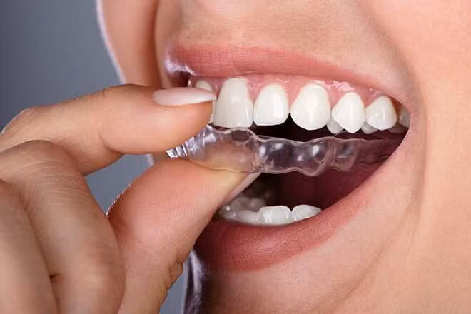 Hàm máng nhựa trong Invisalign được nhiều người ưa chuộng. Ảnh: Mount Pearld Dental