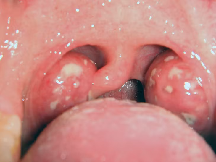 Amidan bị viêm thường sưng to và có mủ