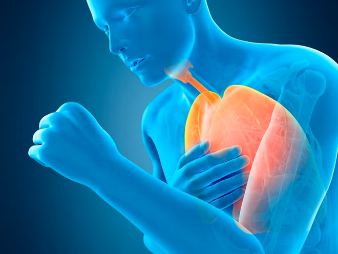 Bệnh phổi tắc nghẽn mạn tính (COPD): Nguyên nhân chính gây bệnh phổi tắc nghẽn mạn tính là tiếp xúc lâu với các chất gây ô nhiễm không khí. Ô nhiễm không khí cũng là tác nhân làm trầm trọng bệnh COPD. Khi tiếp xúc các hạt ô nhiễm, bệnh nhân mắc COPD dễ bị phát bệnh, cấp cứu, thậm chí có nhiều trường hợp tử vong trong hoàn cảnh khắc nghiệt. Ở các nước kém phát triển, COPD chủ yếu xảy ra do sử dụng than để nấu ăn, sưởi ấm... (Ảnh: Mayoclinic)