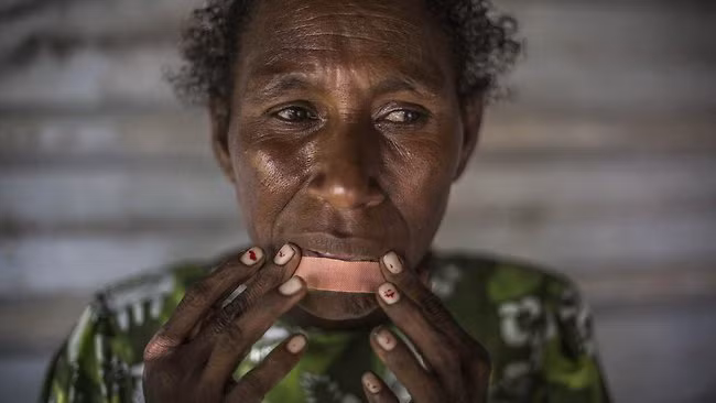 Một phụ nữ Papua New Guinea tên Helen vô cớ bị tấn công ngay tại thủ đô Port Moresby (Papua New Guinea) - Ảnh: AFP