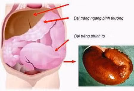  Hình ảnh chụp đại tràng bị phình to.