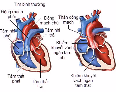 Ống động mạch ở bệnh tim bẩm sinh nặng