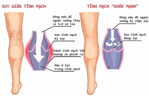 Suy giãn tĩnh mạch là nguyên nhân dẫn đến tình trạng viêm tắc tĩnh mạch chi.