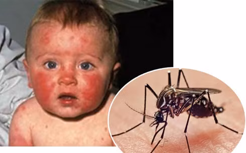 Bệnh Zika lây qua trung gian truyền bệnh là muỗi và khiến cho người bệnh có những nốt đỏ bất thường, sốt cao. (Ảnh: NY)