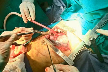 Ca phẫu thuật cứu sống bệnh nhân bị găm 20 viên đạn vào ngực tại BVĐK tỉnh Tuyên Quang.