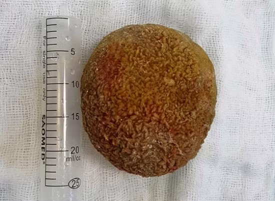 Viên sỏi bàng quang "khủng" có đường kính khoảng 25 cm. Ảnh: Thanh Xuân