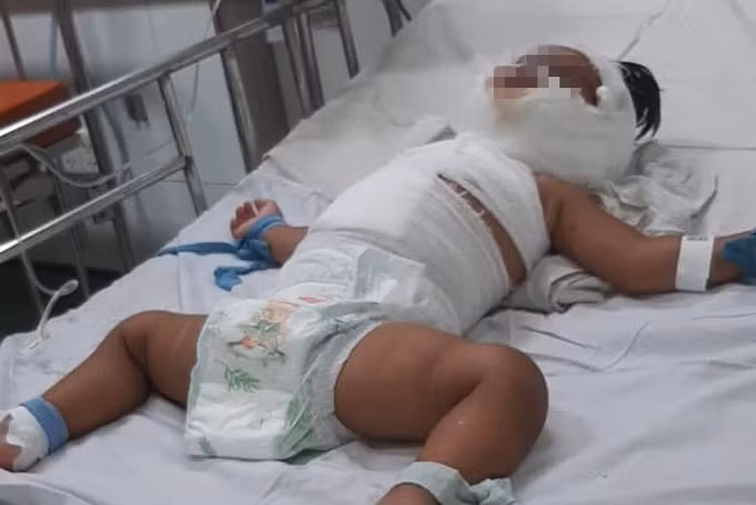 Bé gái bị bỏng nặng sau khi ngã vào nồi nước sôi (Ảnh: CTV).