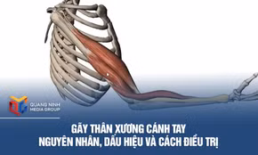 Gãy thân xương cánh tay – Nguyên nhân, dấu hiệu và cách điều trị