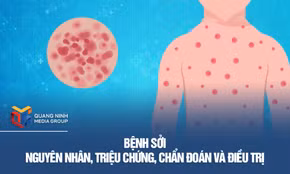 Nguyên nhân, triệu chứng, chẩn đoán và điều trị bệnh sởi