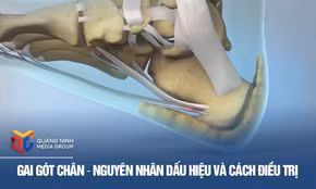 Gai gót chân - Nguyên nhân dấu hiệu và cách điều trị