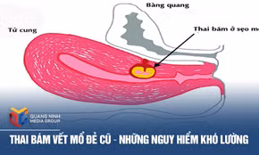 Thai bám vết mổ đẻ cũ – Những nguy hiểm khó lường