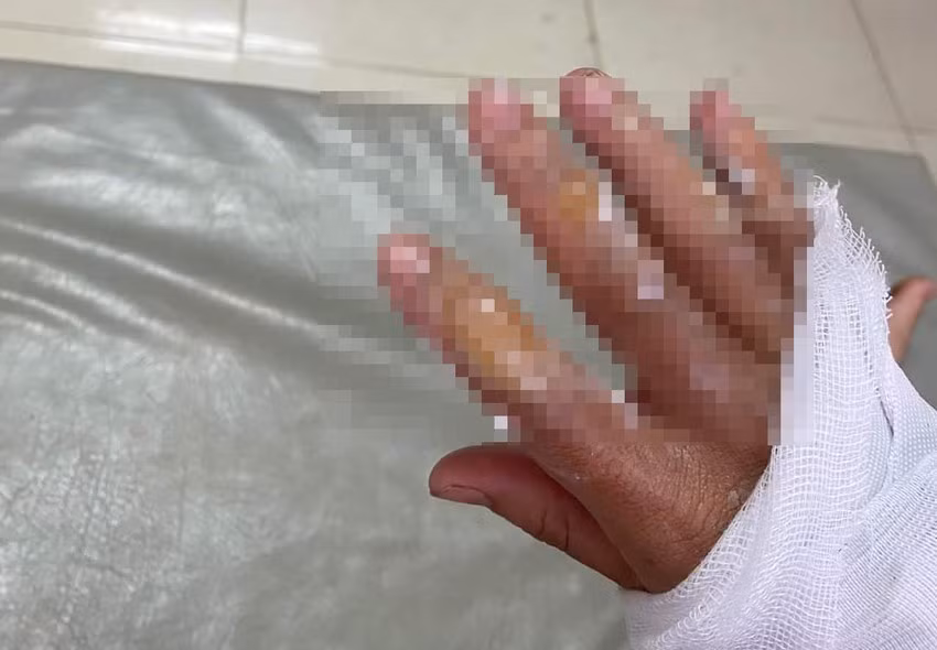 Một người bị bỏng ở tay. Ảnh: AX