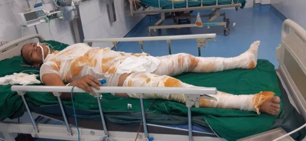 Anh Quy hiện đang điều trị tại Viện Bỏng quốc gia trong tình trạng bỏng nặng và hoàn cảnh gia đình rất khó khăn.