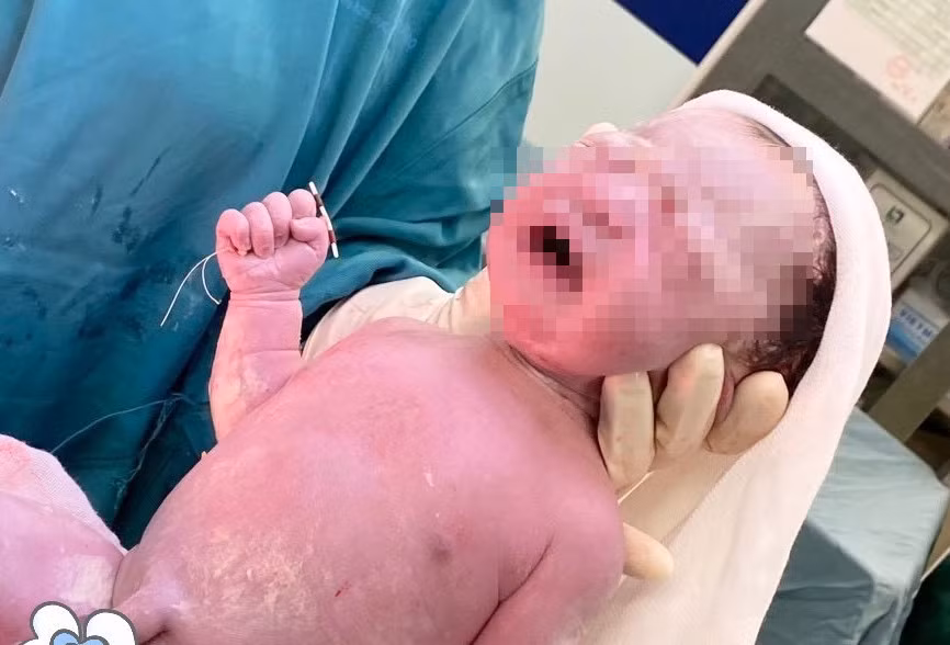 Em bé sơ sinh chào đời với chiếc vòng tránh thai của mẹ. Ảnh: BVCC.