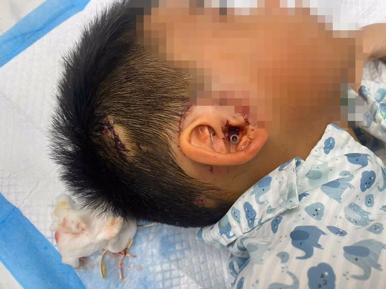 Một bệnh nhi phải nhập viện cấp cứu vì chó nhà cắn, suýt bị đứt mất tai. Ảnh: BVCC